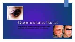 Quemaduras físicas
El paciente se presenta alarmado con la región
afectada eritematosa y dolor leve a intenso.
 