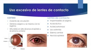 Uso excesivo de lentes de contacto
cornea
 Carente de circulación
 Obtiene oxigeno y se mezcla con la
lagrima
 Difundido en ella alcanza el epitelio y
el estroma anterior
Lentes de contacto
 Impermeables al oxigeno
 Acido láctico
 Acidez estromosa
 Uso sostenido
 Edema corneal
 Necrosis epitelial
 