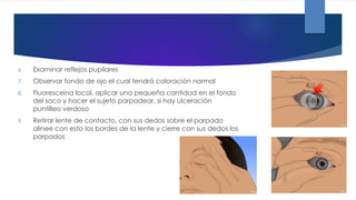 6. Examinar reflejos pupilares
7. Observar fondo de ojo el cual tendrá coloración normal
8. Fluoresceina local, aplicar una pequeña cantidad en el fondo
del saco y hacer el sujeto parpadear, si hay ulceración
puntilleo verdoso
9. Retirar lente de contacto, con sus dedos sobre el parpado
alinee con esto los bordes de la lente y cierre con sus dedos los
parpados
 