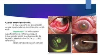 Cuerpo extraño enclavado:
Si hay sospecha de penetración
ocular o profundamente enclavado remitir
a oft.
Tratamiento: Los enclavados
superficialmente, retirar con aguja
intramuscular estéril o un bastoncillo de
algodón, previa instilación de un colirio
anestésico.
Tratar como una erosión corneal
 
