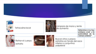 Tetracaína local
Lámpara de mano y lente
de aumento
Retirar el cuerpo
extraño
Buscar otros cuerpos
extraños en fondo del saco
inferior o conjuntiva
palpebral
Determinar si no hay
prolapso uveal y la
profundidad de la
cámara anterior*
 