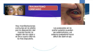 Hay manifestaciones
comunes en la orbita
por la disposición del
macizo facial, la
región de las cejas y
el arco supra ciliar es
la mas expuesta.
Los parpados en la
parte superior pueden
ser edematosos y el
edema palpebral hace
difícil de abrir el ojo.
TRAUMATISMO
ORBITARIO
 