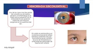 HEMORRAGIA SUBCONJUNTIVAL
Uno de los casos mas frecuentes
de consulta con el medico
general y el oftalmólogo es el
sujeto que se presenta con el
antecedente de aparición
súbita de una mancha
sanguínea en la superficie del
ojo.
El cuadro es asintomático en
ocasiones el paciente refiere
esfuerzos sostenidos de pujo ,
traumatismos leves cambios
bruscos de temperatura o
antecedentes personales de
hipertensión arterial.
Ady Abigail
 