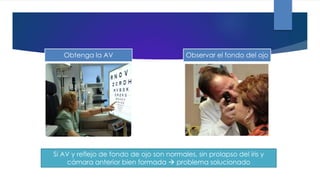 Obtenga la AV Observar el fondo del ojo
Si AV y reflejo de fondo de ojo son normales, sin prolapso del iris y
cámara anterior bien formada  problema solucionado
 