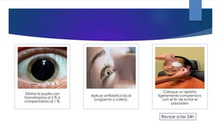 Dilatar la pupila con
homatropina al 2 % o
ciclopentolato al 1 %.
Aplicar antibiótico local
(ungüento o colirio).
Coloque un apósito
ligeramente comprensivo
con el fin de evitar el
parpadeo
Revisar a las 24h
 