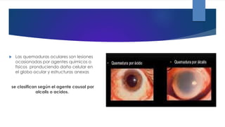  Las quemaduras oculares son lesiones
ocasionadas por agentes quimicos o
fisicos pronduciendo daño celular en
el globo ocular y estructuras anexas
se clasifican según el agente causal por
alcalis o acidos.
 