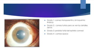  Grado 1: cornea transparente y sin isquemia
limbica
 Grado 2: cornea turbia pero se ven los detalles
del iris
 Grado 3: perdida total del epitelio corneal
 Grado 4 : cornea opaca
 