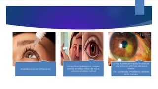 Anestésico local (tetracaína)
conjuntiva hiperemica, cornea
perdió el reflejo nítido de la luz,
cámara anterior normal
Si hay fluoresceína sódica colocar
una gota en el fondo del saco
inferior
Dx: punteado amarillento verdoso
en la cornea.
 
