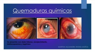 Quemaduras químicas
MARTHA ALEJANDRA WONG MUÑOZ
Se presenta con dolor intenso, enrojecimiento,
blefarospasmos y lagrimeo
 
