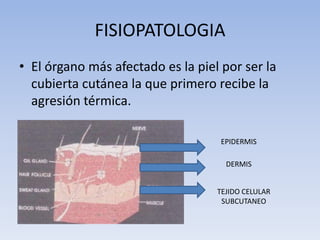 FISIOPATOLOGIA
• El órgano más afectado es la piel por ser la
  cubierta cutánea la que primero recibe la
  agresión térmica.

                                    EPIDERMIS

                                     DERMIS


                                   TEJIDO CELULAR
                                    SUBCUTANEO
 