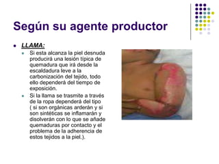 Según su agente productor
   LLAMA:
       Si esta alcanza la piel desnuda
        producirá una lesión típica de
        quemadura que irá desde la
        escaldadura leve a la
        carbonización del tejido, todo
        ello dependerá del tiempo de
        exposición.
       Si la llama se trasmite a través
        de la ropa dependerá del tipo
        ( si son orgánicas arderán y si
        son sintéticas se inflamarán y
        disolverán con lo que se añade
        quemaduras por contacto y el
        problema de la adherencia de
        estos tejidos a la piel.).
 