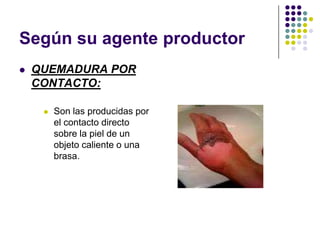 Según su agente productor
   QUEMADURA POR
    CONTACTO:

        Son las producidas por
         el contacto directo
         sobre la piel de un
         objeto caliente o una
         brasa.
 