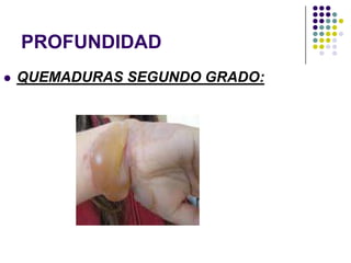 PROFUNDIDAD
   QUEMADURAS SEGUNDO GRADO:
 