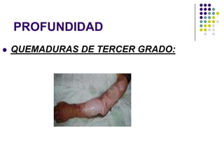 PROFUNDIDAD
   QUEMADURAS DE TERCER GRADO:
 