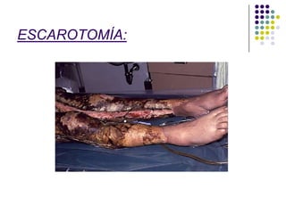 ESCAROTOMÍA:
 