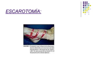 ESCAROTOMÍA:
 