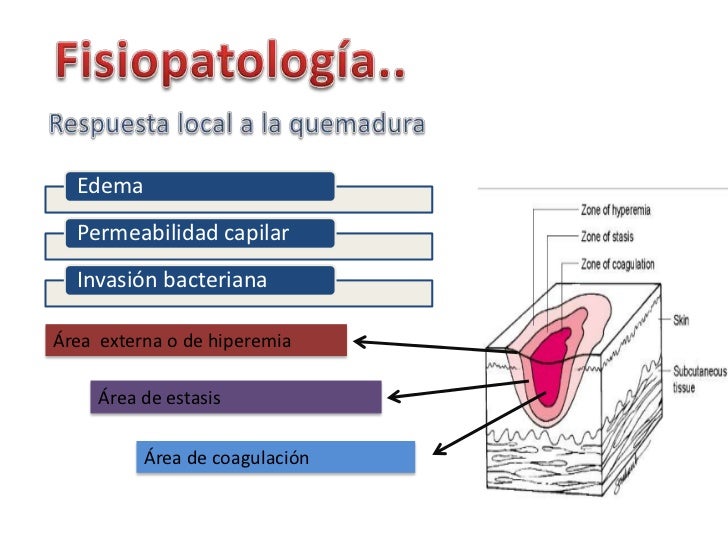 Quemaduras