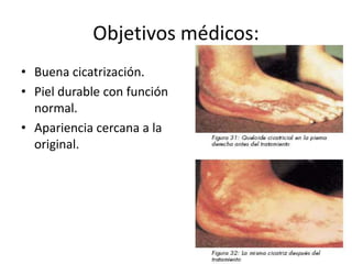 Objetivos médicos:
• Buena cicatrización.
• Piel durable con función
  normal.
• Apariencia cercana a la
  original.
 