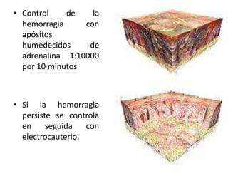 • Control    de    la
  hemorragia     con
  apósitos
  humedecidos     de
  adrenalina 1:10000
  por 10 minutos



• Si la hemorragia
  persiste se controla
  en     seguida   con
  electrocauterio.
 