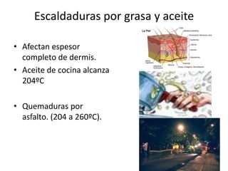 Escaldaduras por grasa y aceite

• Afectan espesor
  completo de dermis.
• Aceite de cocina alcanza
  204ºC

• Quemaduras por
  asfalto. (204 a 260ºC).
 