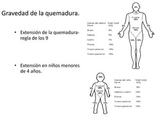 Gravedad de la quemadura.

    • Extensión de la quemadura-
      regla de los 9




    • Extensión en niños menores
      de 4 años.
 