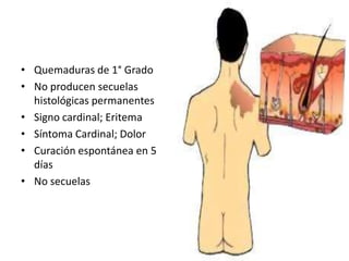 • Quemaduras de 1° Grado
• No producen secuelas
  histológicas permanentes
• Signo cardinal; Eritema
• Síntoma Cardinal; Dolor
• Curación espontánea en 5
  días
• No secuelas
 