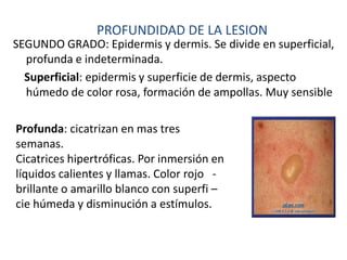 PROFUNDIDAD DE LA LESION
SEGUNDO GRADO: Epidermis y dermis. Se divide en superficial,
  profunda e indeterminada.
  Superficial: epidermis y superficie de dermis, aspecto
  húmedo de color rosa, formación de ampollas. Muy sensible

Profunda: cicatrizan en mas tres
semanas.
Cicatrices hipertróficas. Por inmersión en
líquidos calientes y llamas. Color rojo -
brillante o amarillo blanco con superfi –
cie húmeda y disminución a estímulos.
 