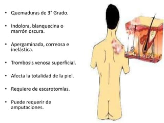 • Quemaduras de 3° Grado.

• Indolora, blanquecina o
  marrón oscura.

• Apergaminada, correosa e
  inelástica.

• Trombosis venosa superficial.

• Afecta la totalidad de la piel.

• Requiere de escarotomías.

• Puede requerir de
  amputaciones.
 