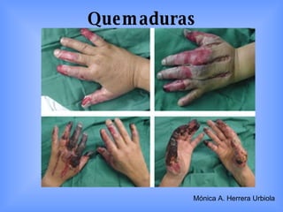 Quemaduras Mónica A. Herrera Urbiola 
