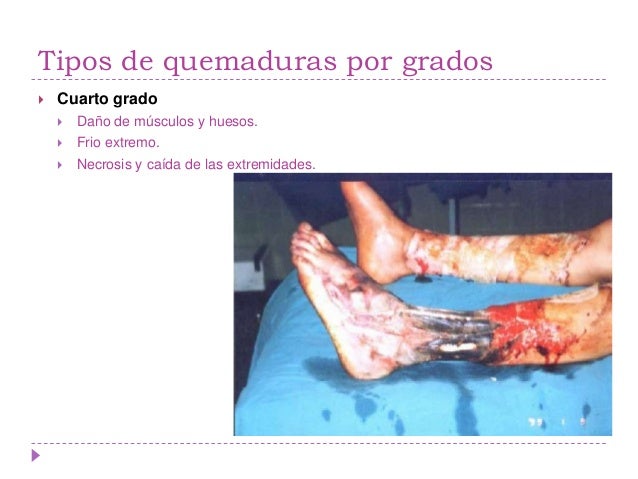 Quemaduras Quemaduras