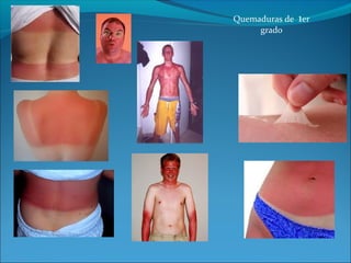 Quemaduras de 1er
grado

 