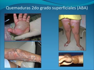 Quemaduras 2do grado superficiales (ABA)

 