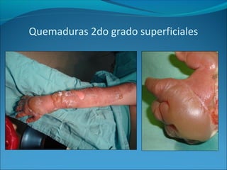 Quemaduras 2do grado superficiales

 