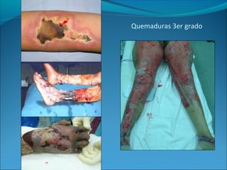 Quemaduras 3er grado

 