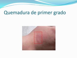 Quemadura de primer grado
 