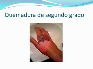 Quemadura de segundo grado
 