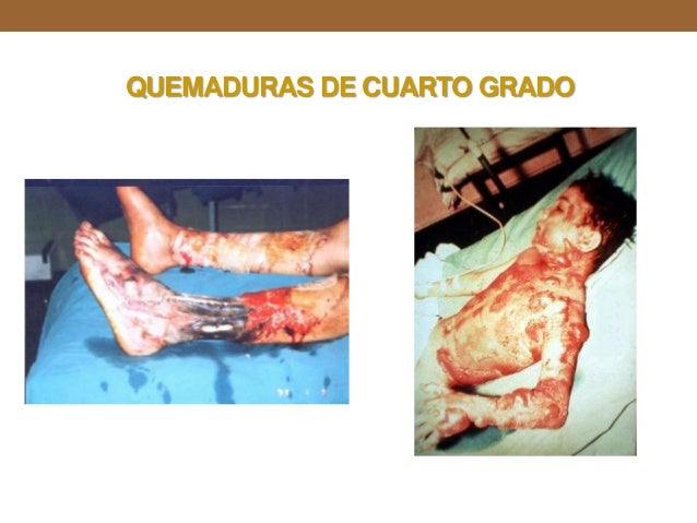 Quemaduras Quemaduras