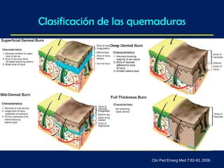 Clasificación de las quemaduras
Clin Ped Emerg Med 7:82-93, 2006.
 