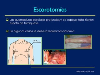 Escarotomías
BMJ 2004;329;101-103.
 Las quemaduras parciales profundas y de espesor total tienen
efecto de torniquete.
 En algunos casos se deberá realizar fasciotomía.
 