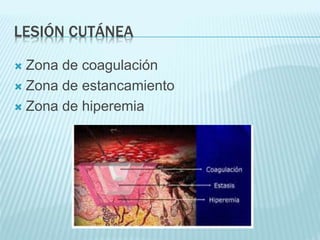LESIÓN CUTÁNEA
 Zona de coagulación
 Zona de estancamiento
 Zona de hiperemia
 