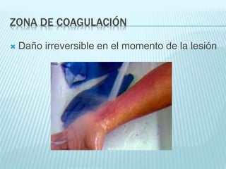 ZONA DE COAGULACIÓN
 Daño irreversible en el momento de la lesión
 