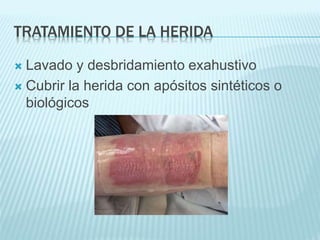 TRATAMIENTO DE LA HERIDA
 Lavado y desbridamiento exahustivo
 Cubrir la herida con apósitos sintéticos o
biológicos
 