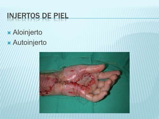 INJERTOS DE PIEL
 Aloinjerto
 Autoinjerto
 