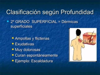 Clasificación según ProfundidadClasificación según Profundidad
 2º GRADO SUPERFICIAL = Dérmicas2º GRADO SUPERFICIAL = Dérmicas
superficialessuperficiales
 Ampollas y flictenasAmpollas y flictenas
 ExudativasExudativas
 Muy dolorosasMuy dolorosas
 Curan espontáneamenteCuran espontáneamente
 Ejemplo: EscaldaduraEjemplo: Escaldadura
 