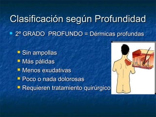 Clasificación según ProfundidadClasificación según Profundidad
 2º GRADO PROFUNDO = Dérmicas profundas2º GRADO PROFUNDO = Dérmicas profundas
 Sin ampollasSin ampollas
 Más pálidasMás pálidas
 Menos exudativasMenos exudativas
 Poco o nada dolorosasPoco o nada dolorosas
 Requieren tratamiento quirúrgicoRequieren tratamiento quirúrgico
 