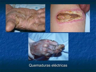 Quemaduras eléctricasQuemaduras eléctricas
 