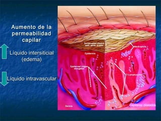 Aumento de laAumento de la
permeabilidadpermeabilidad
capilarcapilar
Líquido intersiticialLíquido intersiticial
(edema)(edema)
Líquido intravascularLíquido intravascular
Capilares dilatados
 