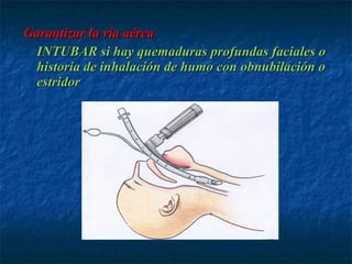 Garantizar la vía aéreaGarantizar la vía aérea
INTUBAR si hay quemaduras profundas faciales oINTUBAR si hay quemaduras profundas faciales o
historia de inhalación de humo con obnubilación ohistoria de inhalación de humo con obnubilación o
estridorestridor
 