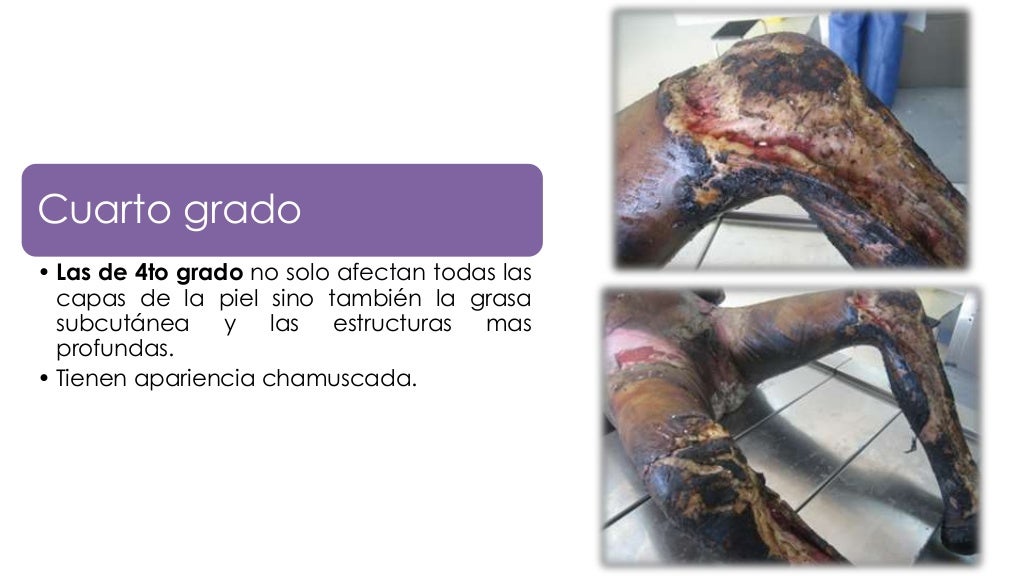 Quemaduras Quemaduras