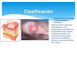 Clasificación
 Segundo grado superficial
(superficial partial
thickness):
Afectan hasta la capa basal
de la epidermis. Son
producidas por escaldaduras
o exposición breve a llamas.
Presentan ampollas, con
hiperhemia y exudación y
una intensa sensibilidad.
Curan en un periodo variable
de 7-14 días.
 